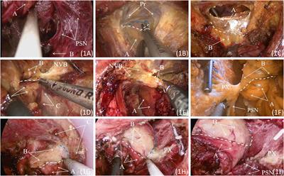 Transanal total mesorectal excision: single center study on risk factors for major complications